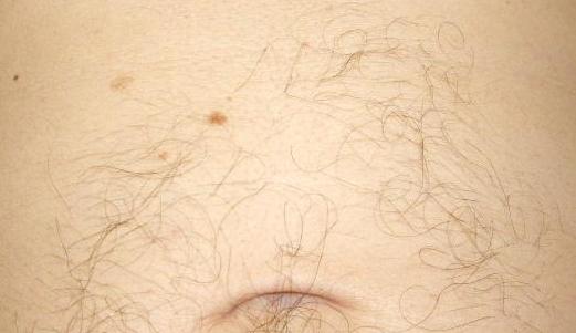 asymmetric abdominal hair