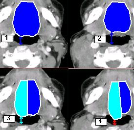 Tongue dislocation model