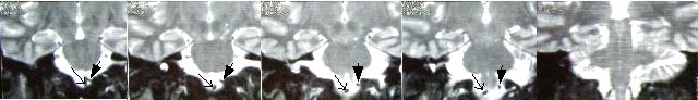 vertebral artery coronal view