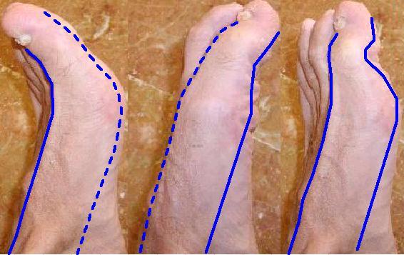 hallux co-contraction disorder