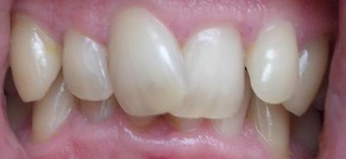 incisor crowded