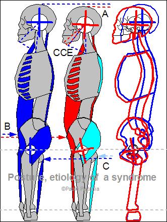 Whole body Cranio-Cervical Extension muscle spasm