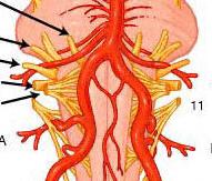 Hypoglossal Emergence Entrapment