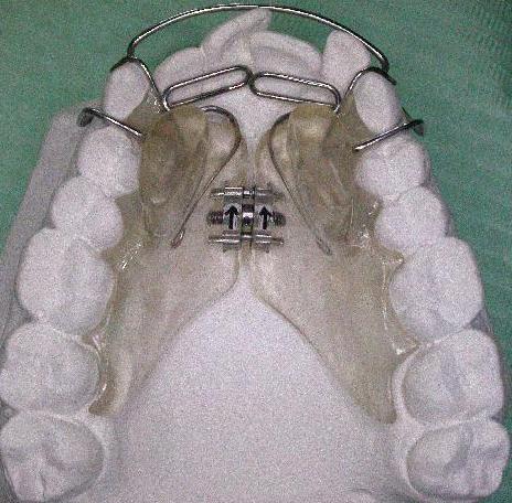 planas on maxillary arch