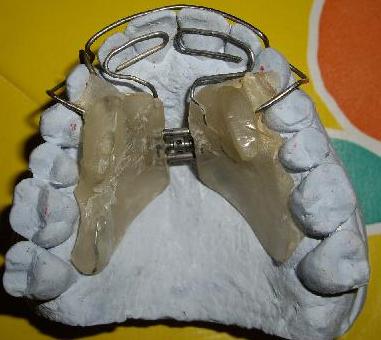 planas on maxillary arch after