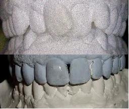 bite occlusion pre/post planas