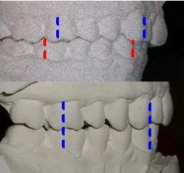 mandible retrusion pre/post planas