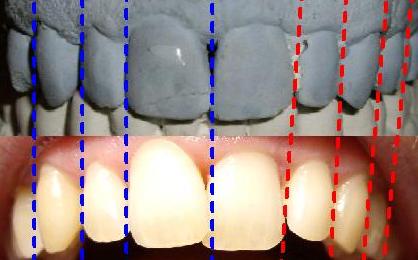 left maxillary arch collapse