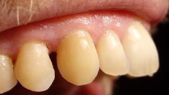 diastema witness arch stability