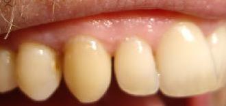 diastema witness arch stability