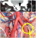 Hypoglossal Rootlets Emergence Compression