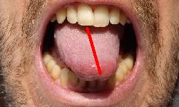 deviated tongue